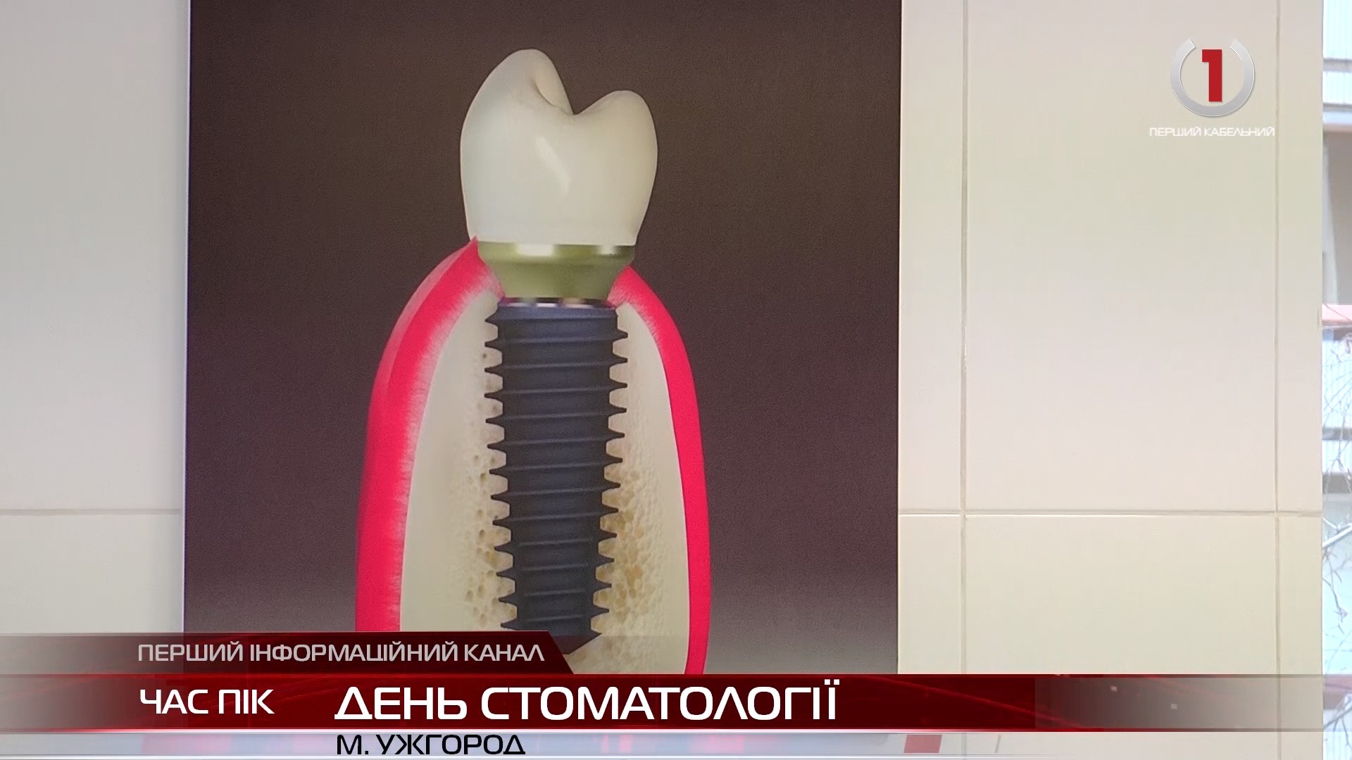 День стоматології в Ужгороді : сучасна імплантація зубів і труднощі хірургії
