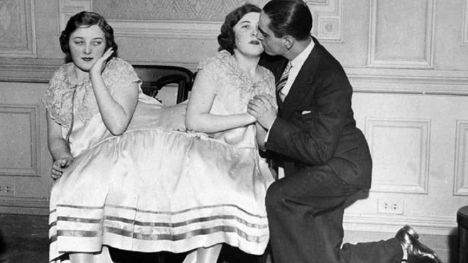 Як народжуються і живуть сіамські близнюки: фото