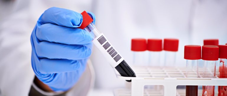 Жовтяниця шкіри, температура та слабкість: з наступного тижня в Ужгороді безкоштовно тестуватимуть на гепатит та ВІЛ