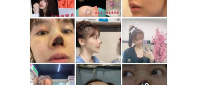 Ніс почорнів і почався некроз. Як акторка постраждала від ринопластики