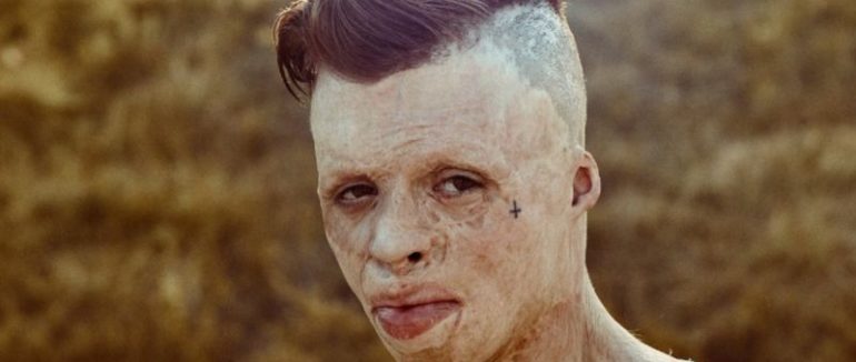 “Вогняна дитина”. Історія хлопця, що вижив у ДТП з опіками 90%