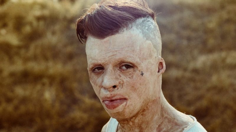 "Вогняна дитина". Історія хлопця, що вижив у ДТП з опіками 90%