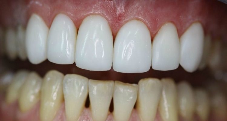 Чому жовтіють зуби: як з цим боротись