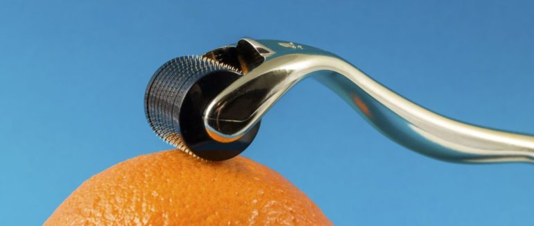 Місія здійсненна: як позбутися целюліту