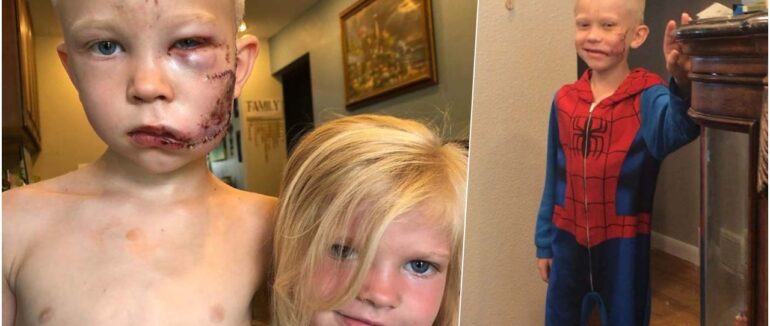 Маленький герой отримав 90 швів та похвалу від героїв блокбастеру: у США 6-річний хлопчик врятував молодшу сестричку від злої собаки