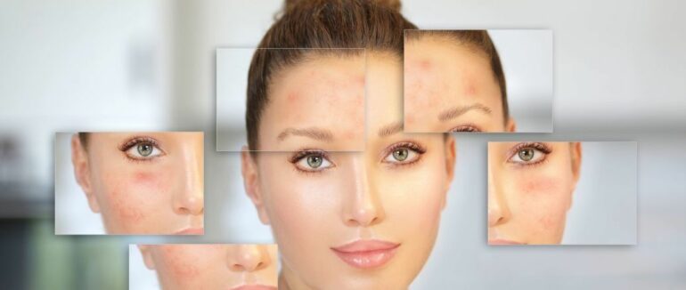 Проблемна шкіра: причини, симптоми і правила догляду