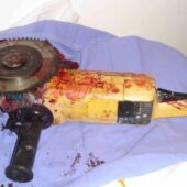 На Мукачівщині чоловік отримав травми обличчя під час робіт з «болгаркою»