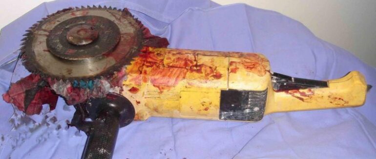 На Мукачівщині чоловік отримав травми обличчя під час робіт з «болгаркою»