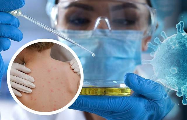 Перший випадок: в Україні виявили мавп’ячу віспу