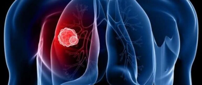 Статистика на Закарпатті: із початку року медики надали допомогу більше тисячі закарпатцям із туберкульозом