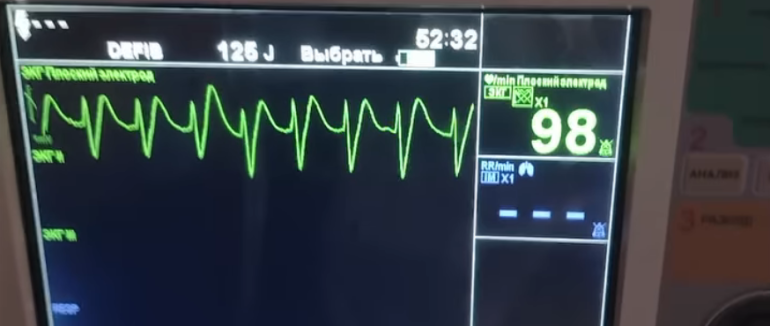 Ознаки клінічної смерті: закарпатські медики врятували життя чоловіку