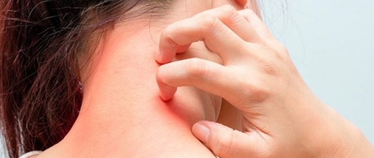 Найпоширеніші ознаки алергії на собак та кішок, на їжу, цвіль