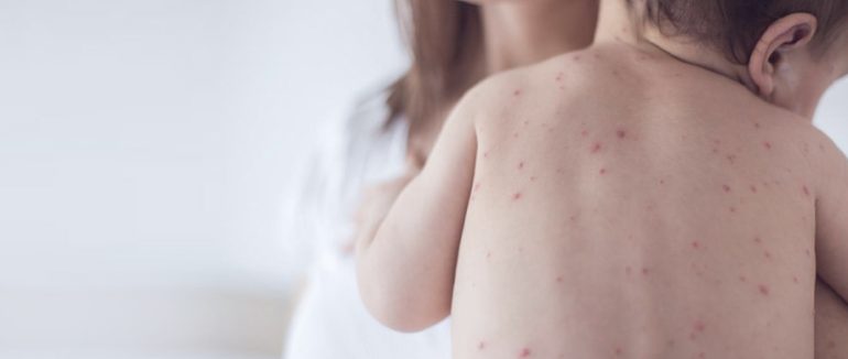 У Мукачівській громаді зафіксували 9 випадків захворювання на кір серед дітей