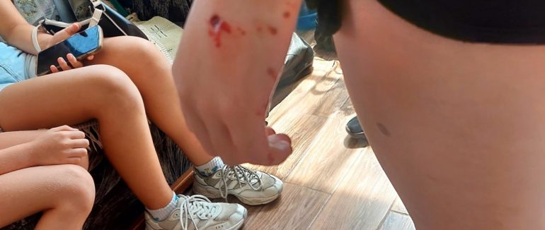 В Ужгороді собаки покусали дитину – мешканці б’ють на сполох