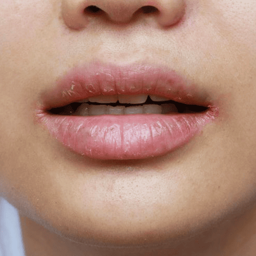 Чому сохнуть губи: які помилки погіршують проблему та як повернути їм здоровий вигляд