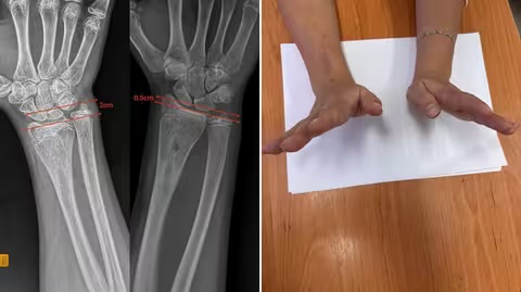 Закарпатські медики вилікували складну деформацію передпліччя у 12-річної пацієнтки