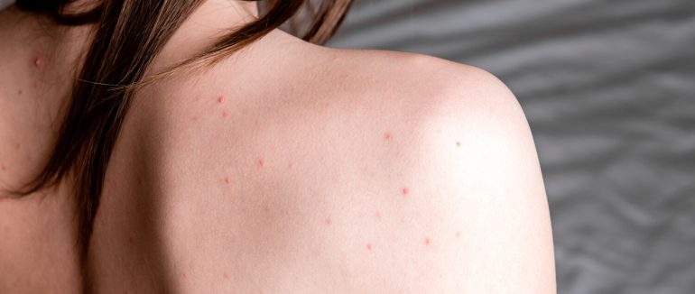 Чому не варто видавлювати прищі на спині та які неприємні наслідки цього можна отримати